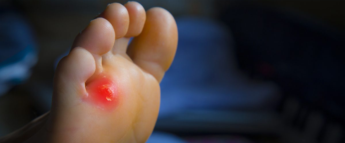 Corns-on-Your-Feet-Here-s-How-the-Right-Shoes-Can-Help-Prevent-and-Relieve-Pain G-defy