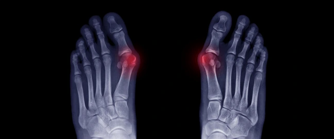 Hammer-Toes-What-They-Are-Why-They-Hurt-and-How-g-defy-Shoes-Can-Help G-defy