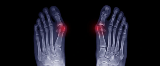 Hammer-Toes-What-They-Are-Why-They-Hurt-and-How-g-defy-Shoes-Can-Help G-defy