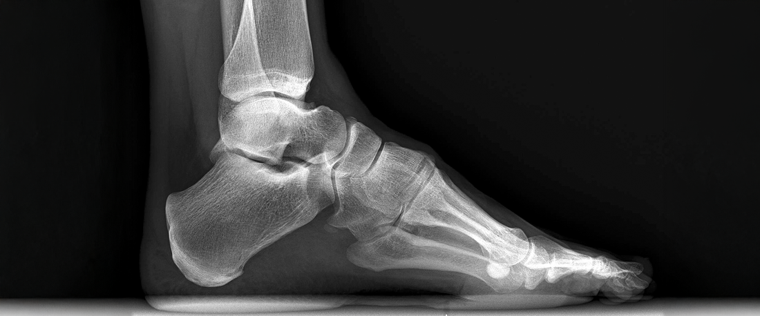 High-Arches-What-They-Mean-for-Your-Feet-and-How-G-Defy-Shoes-Can-Help G-defy