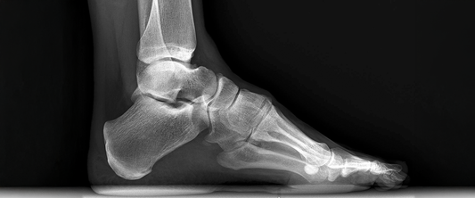 High-Arches-What-They-Mean-for-Your-Feet-and-How-G-Defy-Shoes-Can-Help G-defy