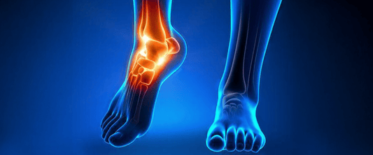 Achilles Tendinitis: What It Is, Why It Hurts, and How g-defy Can Help - G-defy