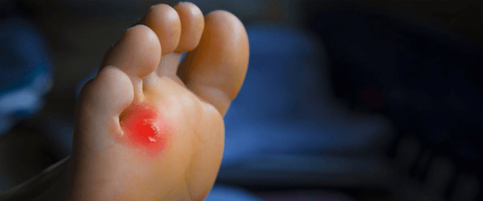 Corns on Your Feet? Here’s How the Right Shoes Can Help Prevent and Relieve Pain - G-defy