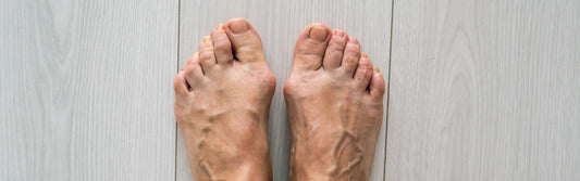 Gout Foot Pain? The Best Shoes for Gout Relief That Keep You Moving - G-defy