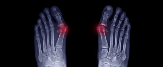 Hammer Toes: What They Are, Why They Hurt, and How g-defy Shoes Can Help - G-defy