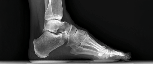 High Arches: What They Mean for Your Feet and How G-Defy Shoes Can Help - G-defy