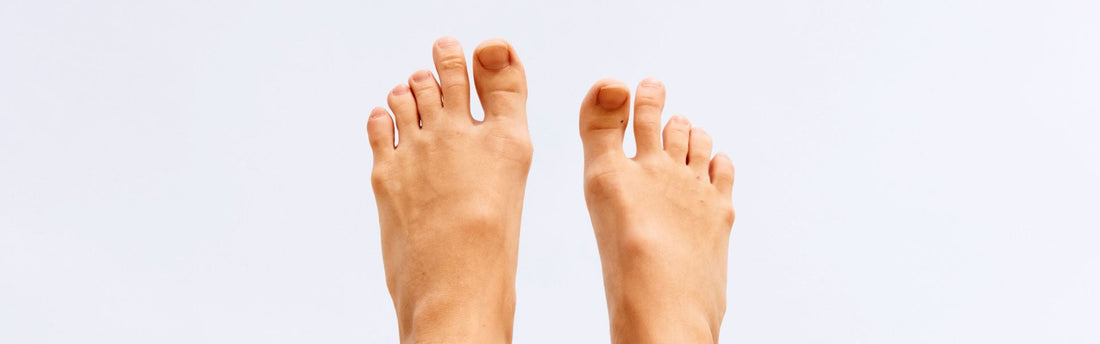 Morton’s Neuroma & Morton’s Toe: What You Need to Know and How g-defy Shoes Can Help - G-defy