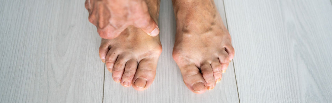What Shoes To Wear With Bunions? - G-defy