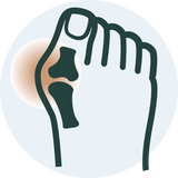 Bunions