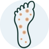 Neuropathy