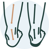 Overpronation
